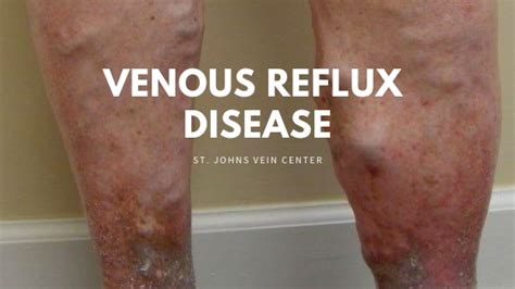 Venous Reflux Disease 101 St Johns Vein Center