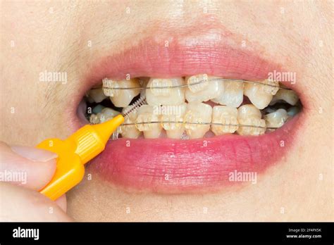 Close Up Crooked Teeth With Braces Interdental Brushing Stock Photo