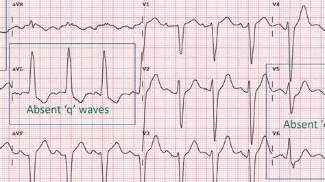 How To Identify Left Bundle Branch Block In An Ecg Youtube