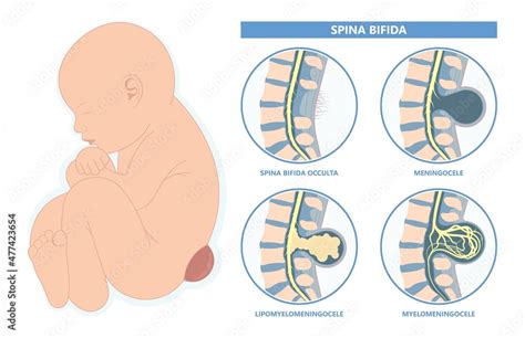 Vettoriale Stock Spina Bifida Pregnancy Non Invasive Neural Tube Gene