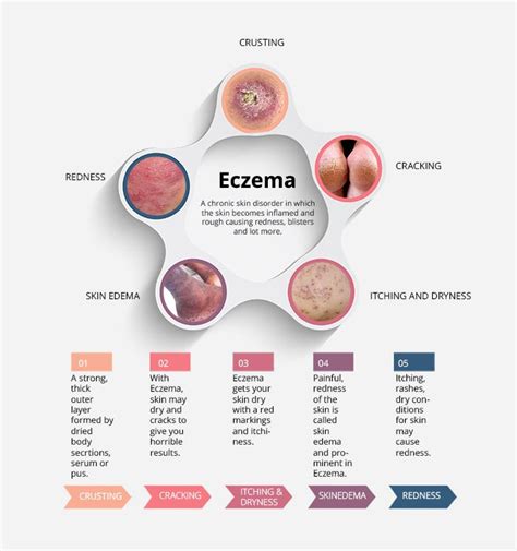 Eczema Living How To Treat Eczema Eczema Cure Eczema Treatment