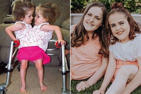 Conjoined Twins Cut In Half At 4 Now Have One Leg Each And Feel Like Everyone Else