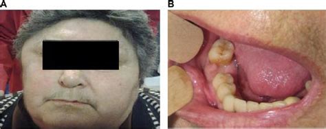 Bisphosphonate Therapy And Osteonecrosis Of The Jaw Complicated With A