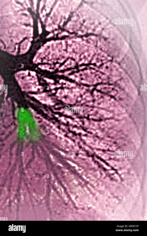 Pulmonary Embolism In The Left Lower Lobe Pulmonary Artery Blocked By