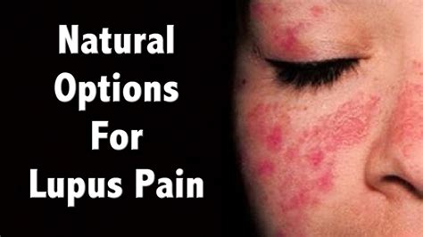 Natural Management Of Lupus Pain And Diet For Lupus Tips Youtube