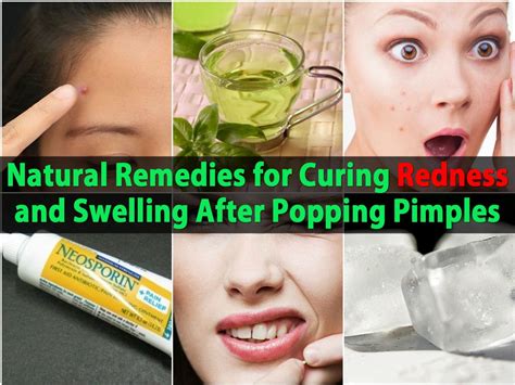 Natural Remedies For Curing Redness And Swelling After Popping Pimples