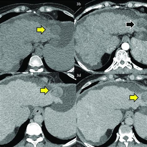 Dynamic Contrast Enhanced Ct Scan Of A Patient With Cirrhosis Of Liver