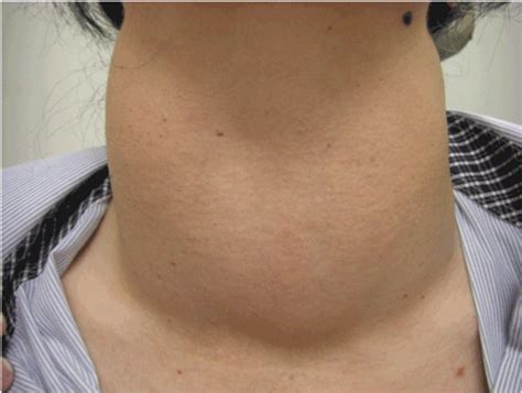 Enlarged Thyroid