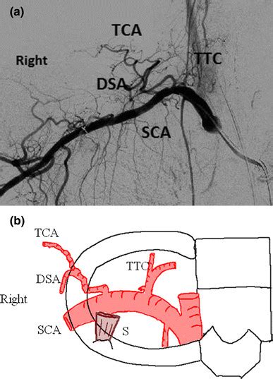 Right Subclavian Artery And Its Branches A Angiographic View The