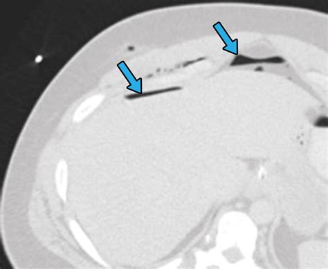 Ct Of Penetrating Abdominopelvic Trauma Radiographics