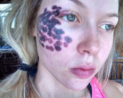 Beauty Blogger Left With Horrific Burns After Laser Treatment For Small Birthmark Thatviralfeed