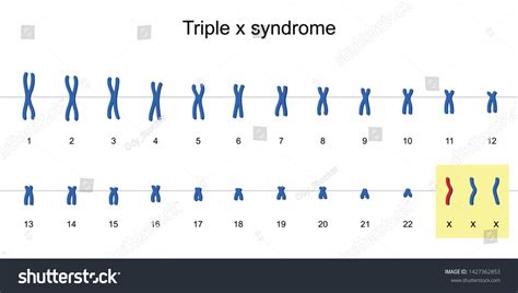Triple X Syndrome Karyotype Nondisjunction Sex Vector De Stock Libre De Regalías 1427362853