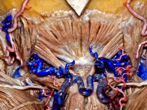 Suboccipital Triangle Muscle Dissection | Neuroanatomy | The