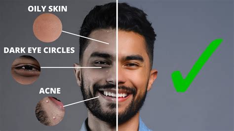 7 Skin Imperfections You Can Fix Overnight Get Rid Of Acne Oily Skin