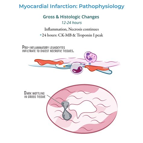 Clinical Pathology Glossary Myocardial Infarction Gross Histologic