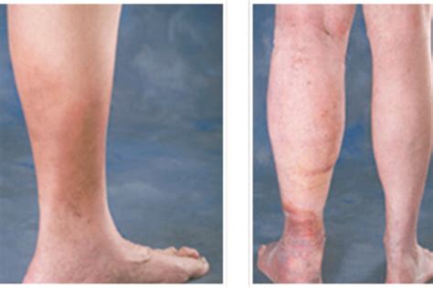 Ankle Discoloration Inovia Vein Specialty Centers Northwest Vein