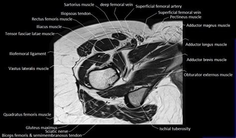 MRI Anatomy Of Hip Joint Free MRI Axial Hip Anatomy In Hip Anatomy Pelvis Anatomy Anatomy