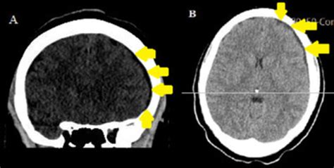 Cureus Intracranial Subdural Hematoma Versus Postdural Puncture