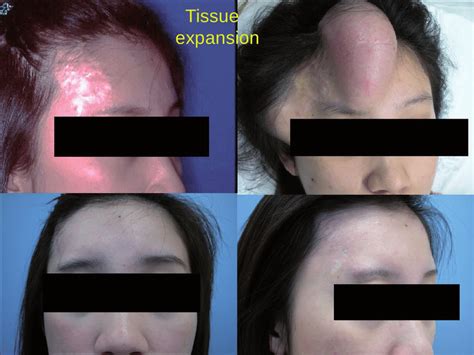 Right Forehead Scar Treated With Tissue Expansion Of Neighboring