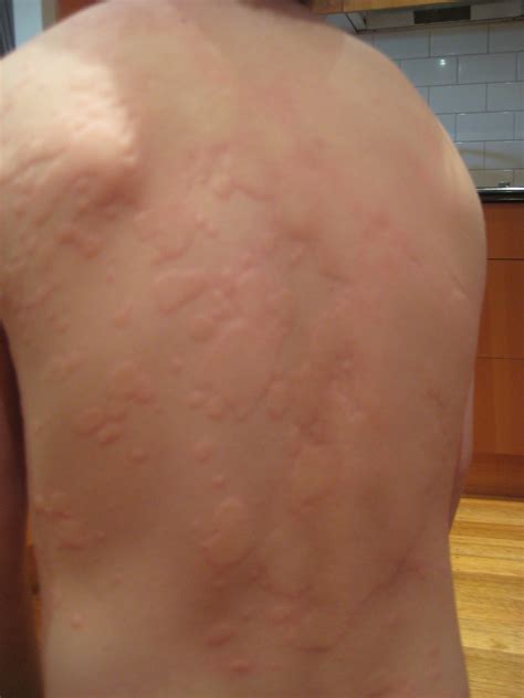 Urticaria Rash On The Skin Photograph By Dr P Marazzi Vrogue Co
