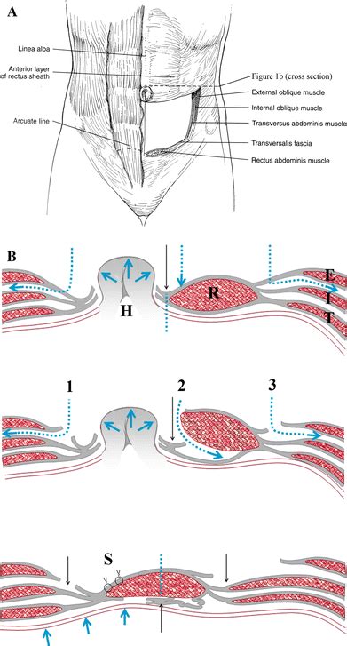 Tensiometry As A Decision Tool For Abdominal Wall Reconstruction With