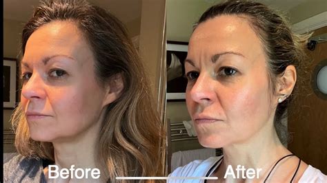 Nuface Microcurrent Before And After Photos Facelift Info Prices My
