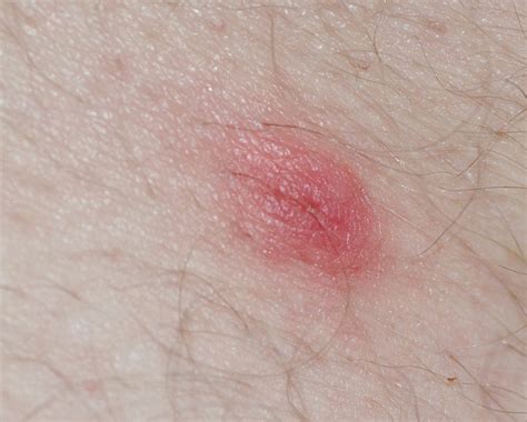 What Does A Tick Bite Look Like Health Images And Pho