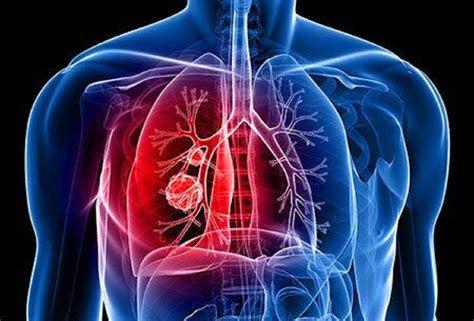 Cancro Ai Polmoni Quali Sono I Sintomi A Cui Fare Attenzione