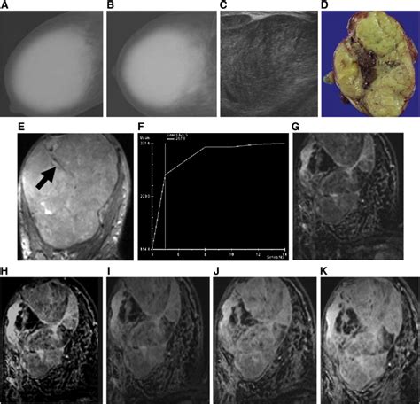 Giant Phyllodes Tumors Of The Breast Imaging Findings With