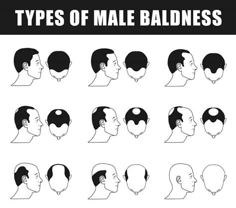 The Stages Of Balding And Treatment Options Aventus Clinic