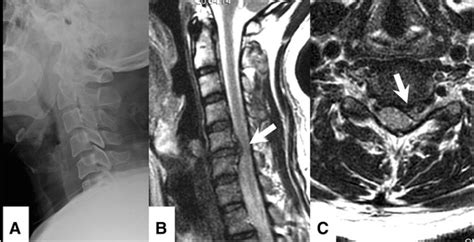 Illustration Case Of Traumatic Cervical Disc Herniation Pre Operative