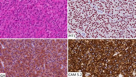 Pathology Outlines Pituitary Neuroendocrine Tumor Pitnet