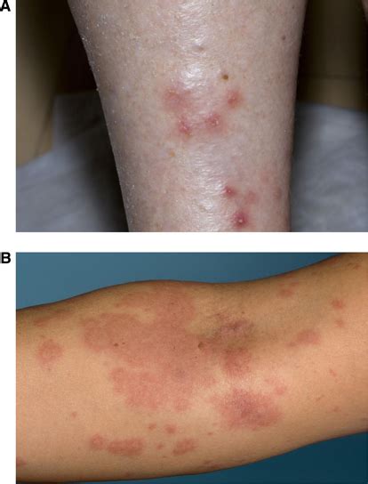 Types Of Skin Rash Caused By Molecularly Targeted Agents