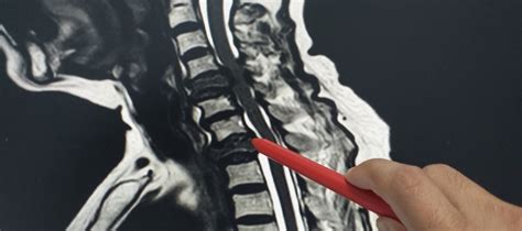 Cervical Spine Mri I Med Radiology Network