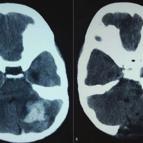 A Computerized Tomography Scan Revealing Vermian Hematoma Type 1