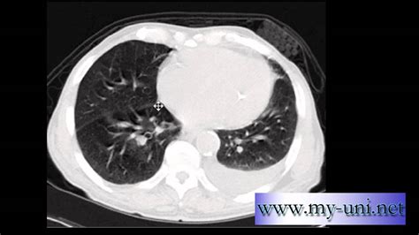 Ct Scan Chest How To Tell If A Patient Is A Smoker Youtube