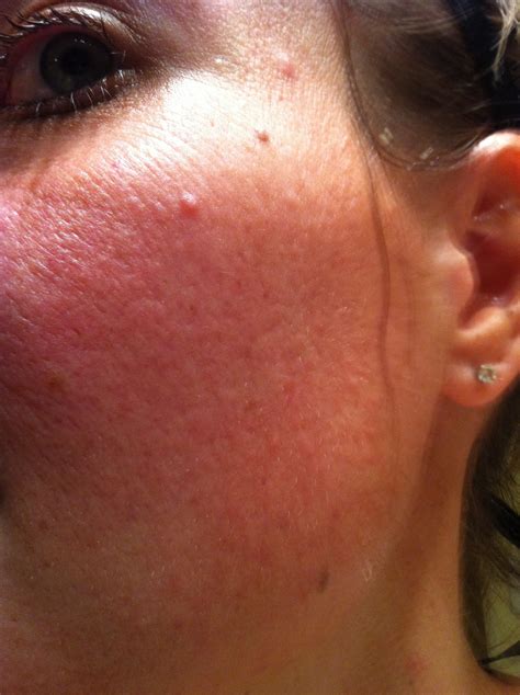 Pimples Around Mouth Herpes Ulcers Small Bumps Under The Skin On