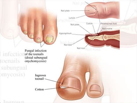 Aggregate More Than 134 Fungal Nail Infection And Diabetes Best Ceg
