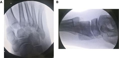 Frontiers Staged Surgery For Closed Lisfranc Injury With Dislocation