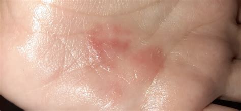 Красное пятно на руке долго непроходит Вопрос дерматологу 03 Онлайн