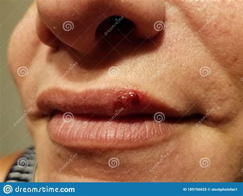 Red Bump Or Sore On Woman`s Upper Lip Stock Image Image Of Cold Nose