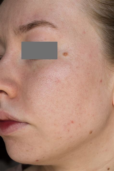 From Fungal Acnefolliculitis To Clear Skin With Pictures Skin Careless