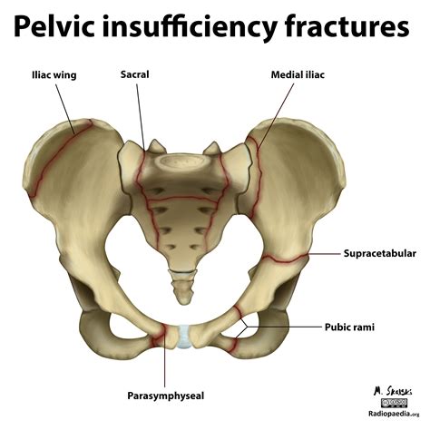 Diagram Pelvic Insufficiency Fractures Image Radiopaedia Org