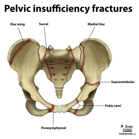 Broken Pelvis In The Elderly Submited Images