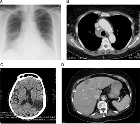 Metastatic Small Cell Lung Cancer Presenting As Fulminant Hepatic
