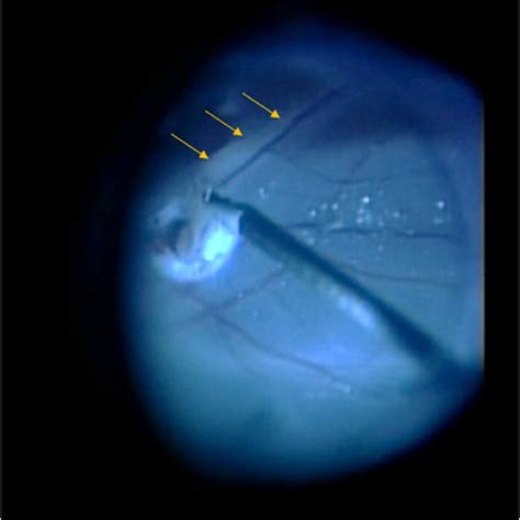 Intraoperative View Of Pars Plana Vitrectomy Subretinal Strand Was