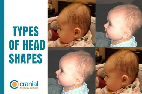 Babies Head Shapes And Their Consequences Cranial Therapy Centers