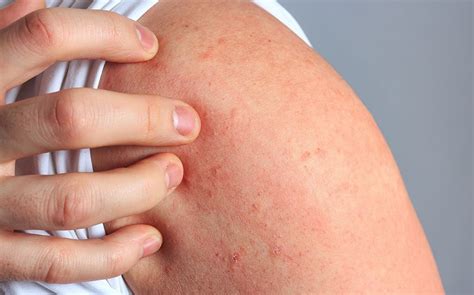 Hives On Skin Picture Of Hives Urticaria Hives Occur When Something