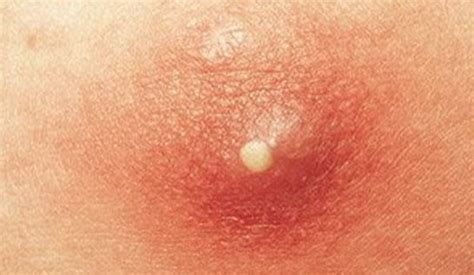Pimple On Labia Pictures Causes And Treatment