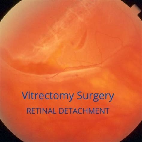 Vitrectomy For Retinal Detachment Board Certified Eye Doctors